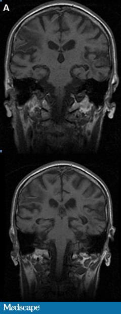 Drooling and Dysphagia in a Man Who Can’t Speak - Page 2