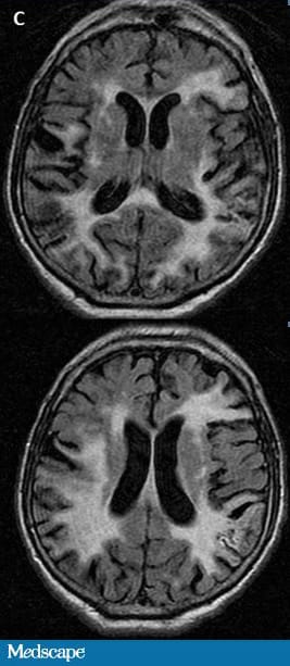 Drooling and Dysphagia in a Man Who Can’t Speak - Page 2