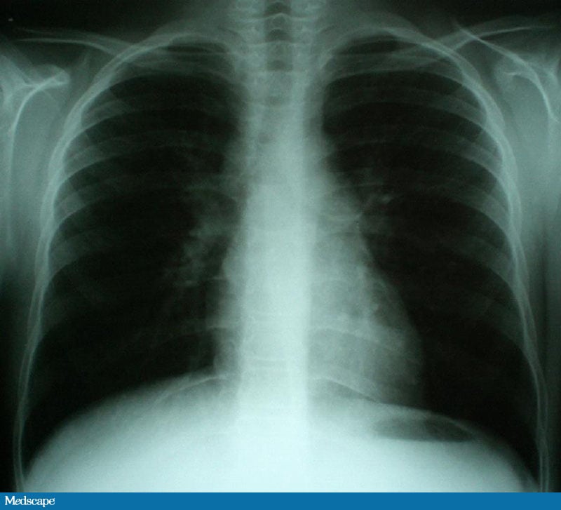 Chronic Gastritis, a Lesion, and Weight Loss in a Teenager - Page 5