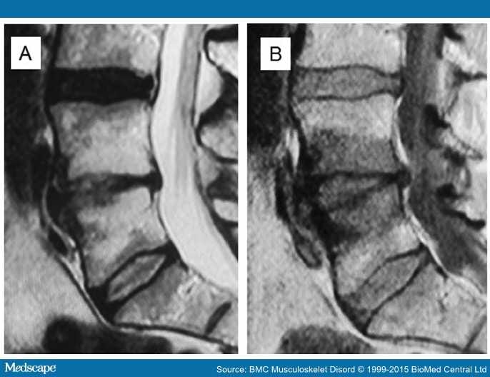 Link Between Lumbar Modic Changes and Low Back Symptoms - Page 4