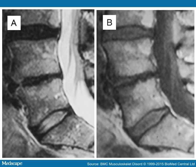 Link Between Lumbar Modic Changes and Low Back Symptoms - Page 4