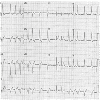 What Patterns Are Apparent in This ECG?