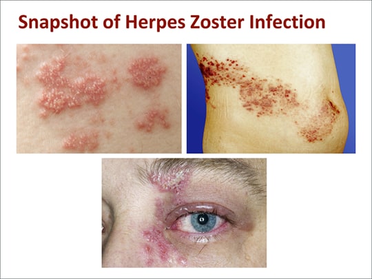 herpes zoster powerpoint presentation