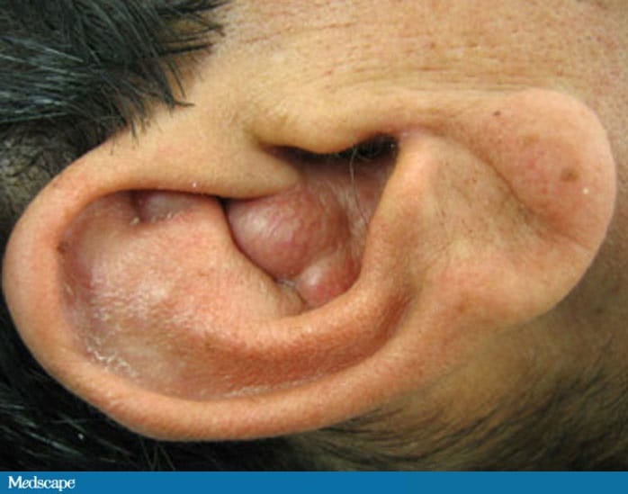 Red Mass In Ear A 42-Year-Old Man With a Right Ear Mass - Page 2