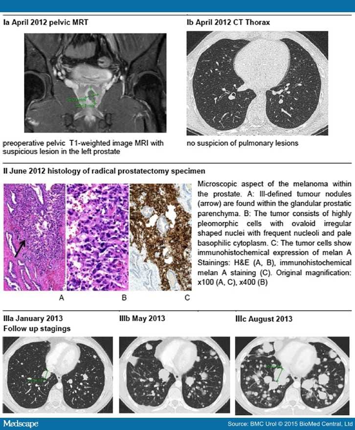 Primary Melanoma of the Prostate - Page 3