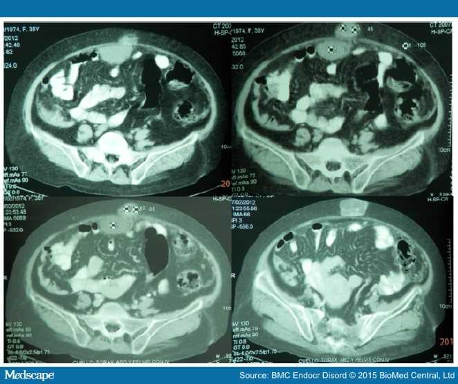 Ectopic ACTH Secretion Associated to Peritoneal Mesothelioma