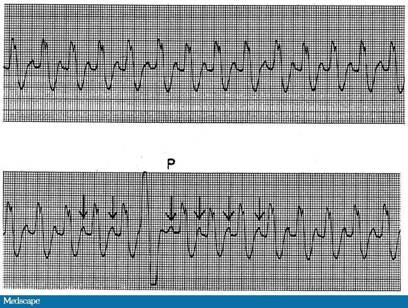 ECG Challenge The Usefulness of PVCs, Part 2 Page 2