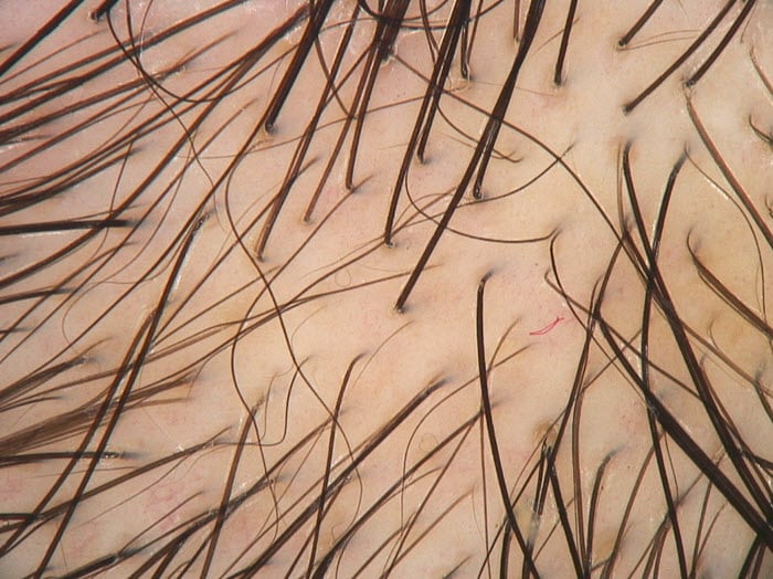 Update on Female Pattern Hair Loss Advances in Diagnosis and Treatment