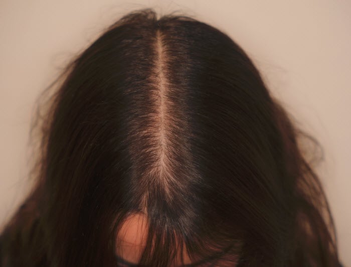 Update on Female Pattern Hair Loss: Advances in Diagnosis 