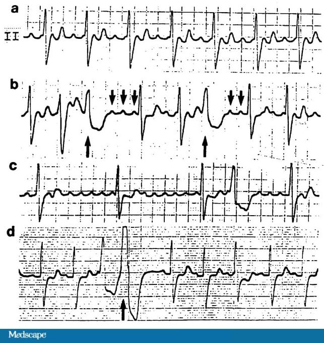 ECG Challenge: The Usefulness of PVCs, Part 3 - Page 2
