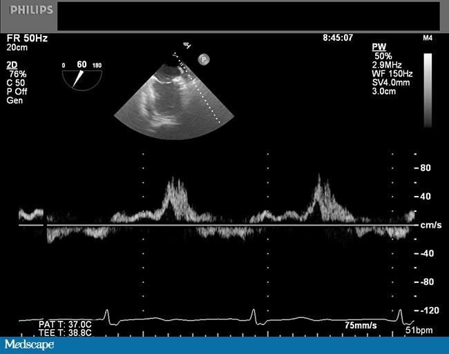 Analyze This Image: Acute HF Requiring Mechanical Ventilation