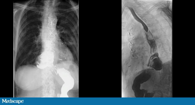 operating-on-recurring-paraesophageal-hernia