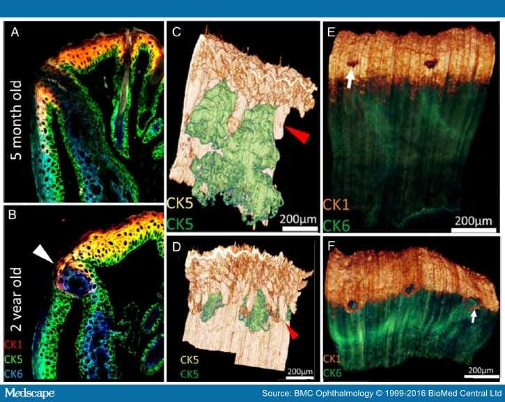Hyperkeratinization Rabbits Meibomian Gland Dysfunction: Hyperkeratinization or Atrophy?