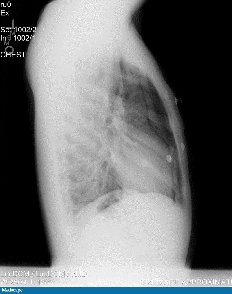 A Marijuana User With Sudden Chest Pain Radiating to His Neck Page 2