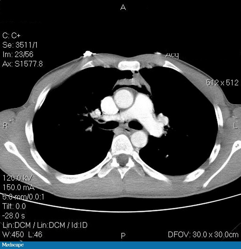A Marijuana User With Sudden Chest Pain Radiating To His Neck Page 3