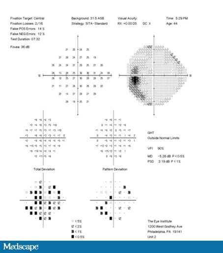 Unilateral Glaucoma?