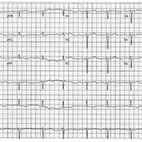 ECG Challenge: What's This Undulation?