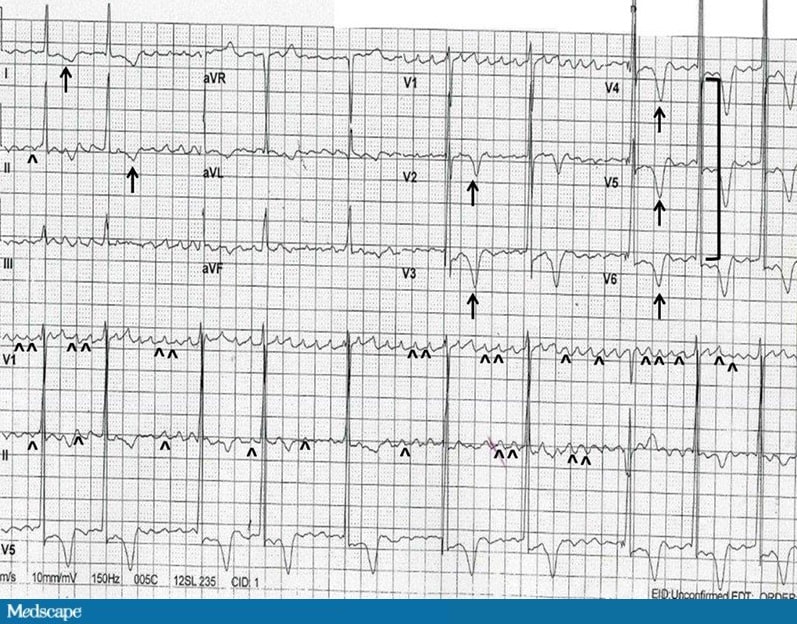 Ecg Challenge What Is This Irregularly Irregular Rhythm