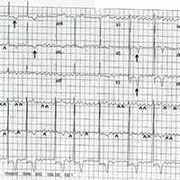 ECG Challenge: What Is This Irregularly Irregular Rhythm? - Page 2