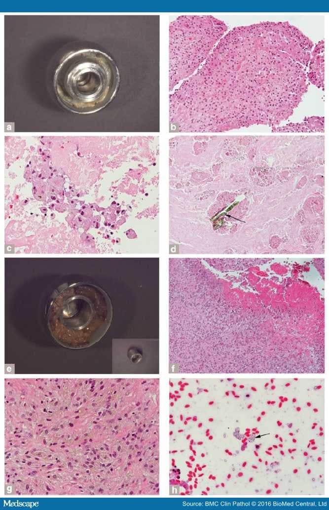 Histopathology and Associated ALTR in Hip Implants - Page 4