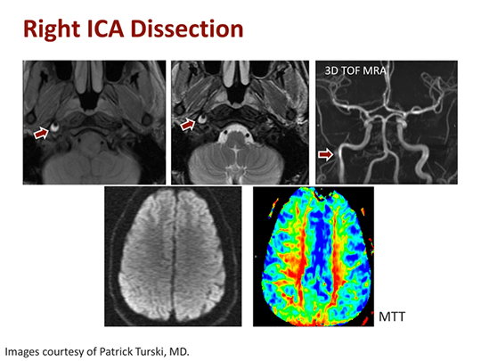Best Practices for the Use of MRA in Stroke Diagnosis (Transcript)