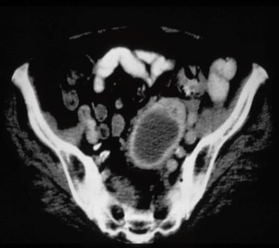 Complicated Intra-abdominal Infections and Multidrug-Resistant Organisms