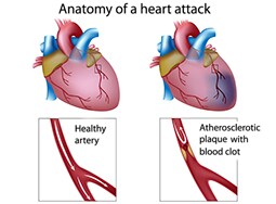 Fast Five Quiz: Myocardial Infarction - Page 4