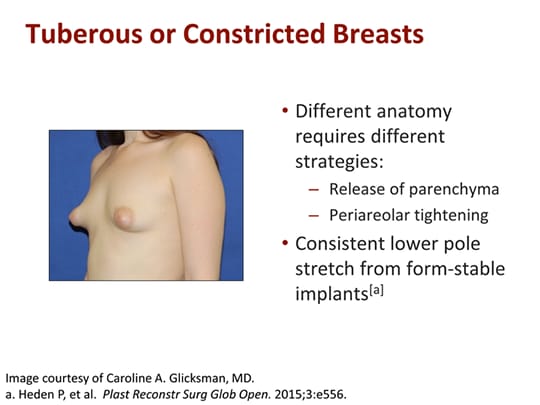 Key Considerations to Optimize Outcomes in Aesthetic Breast