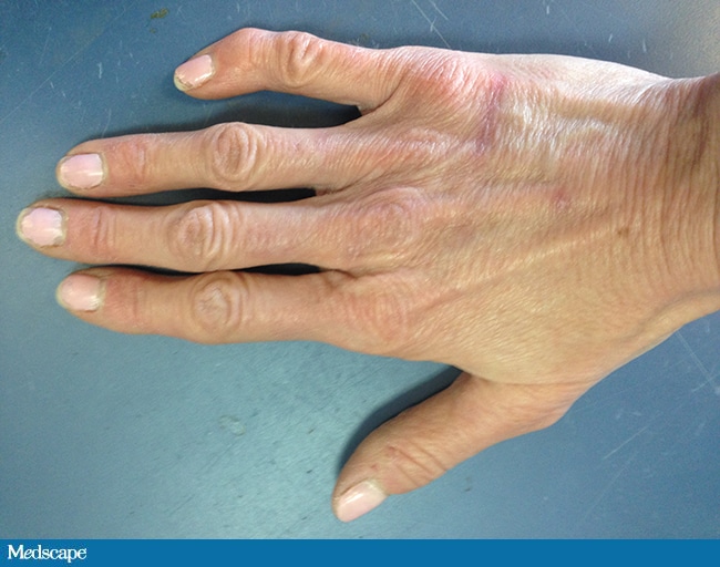 Case Challenge: A 42-Year-Old Woman Unhappy With Her Hand's Appearance