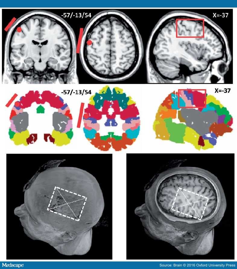 tDCS of the Motor Cortex in Post-Stroke Aphasia
