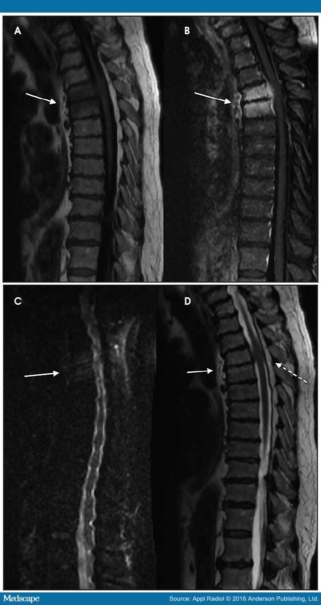 Infections of the Spine: Clinical and Imaging Findings