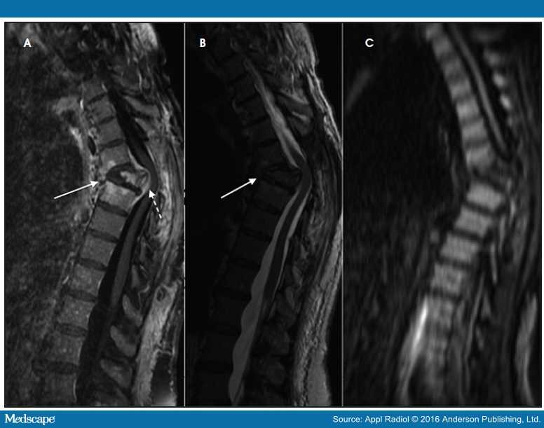 Infections of the Spine: Clinical and Imaging Findings