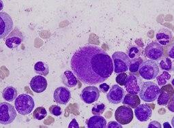 Fast Five Quiz: Chronic Myelogenous Leukemia