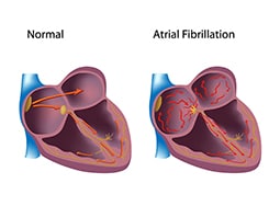 Fast Five Quiz: Atrial Fibrillation - Page 2