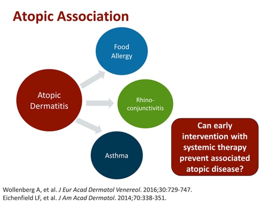 Systemic Treatment For Atopic Dermatitis