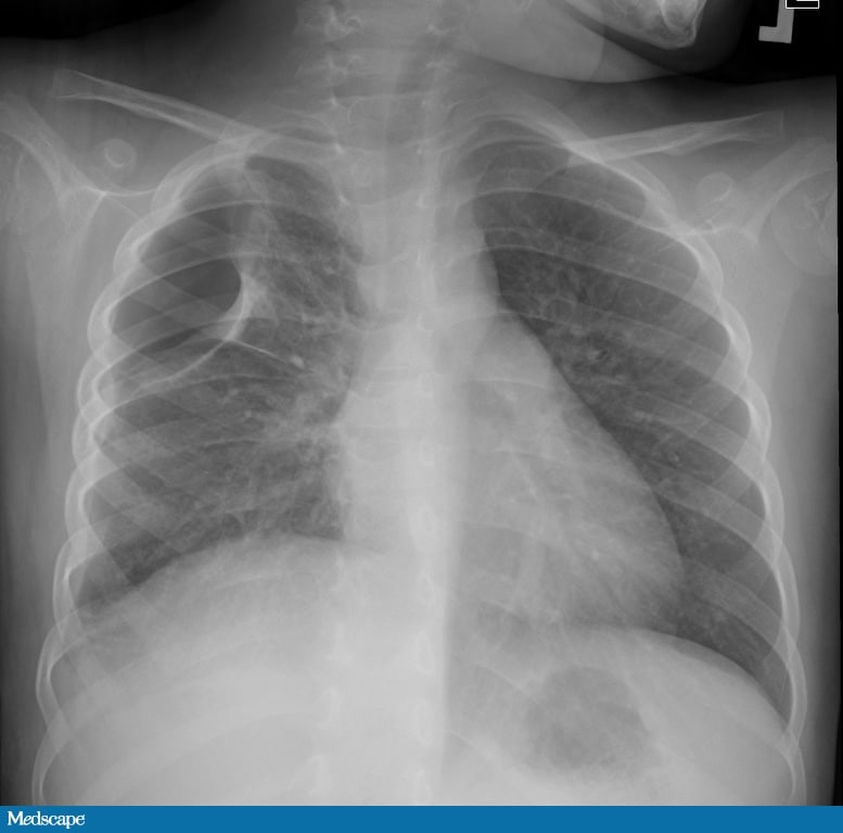 A 5-Year-Old Girl With High Fever and Nonproductive Cough