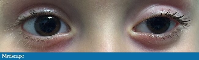 What Causes Involuntary Eyelid Movement