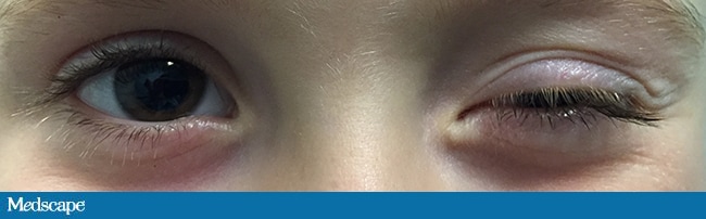 a-child-with-involuntary-and-intermittent-eyelid-movements