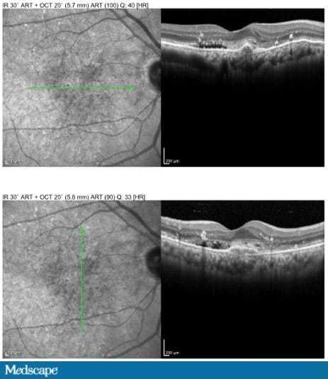 A 66-Year-Old Woman With Central Vision Loss - Page 2