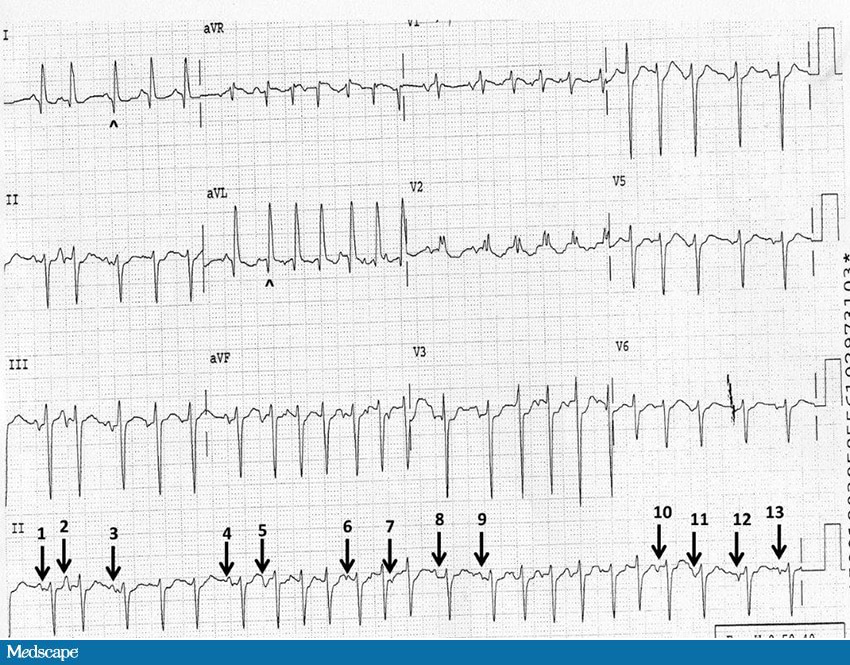 ECG Challenge: Short of Breath With a Fast Pulse - Page 2