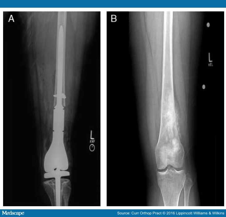 Surgery for Bone Sarcomas of the Lower Extremity