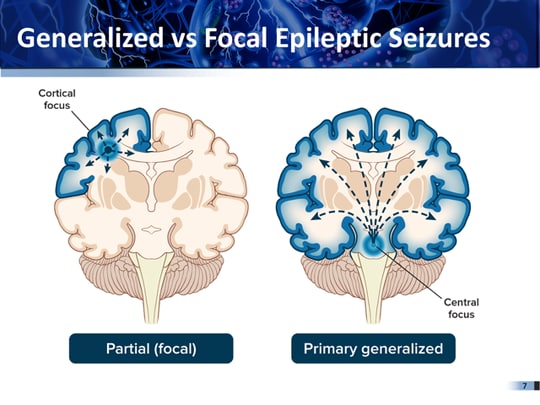 epilepsy eeg vs normal eeg