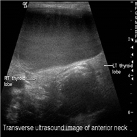 A 45-Year-Old Man With Gradual Neck Swelling - Page 3