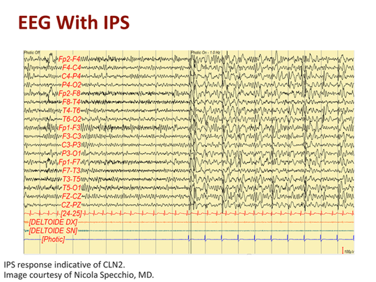 Updates in Neuronal Ceroid Lipofuscinosis: A Focus on CLN2 (Transcript)