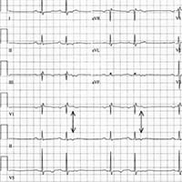 ECG Challenge: Examine the P in these Pairs - Page 2