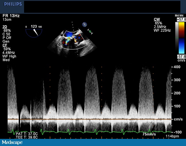 Normal Bioprosthetic Aortic Valve Gradients