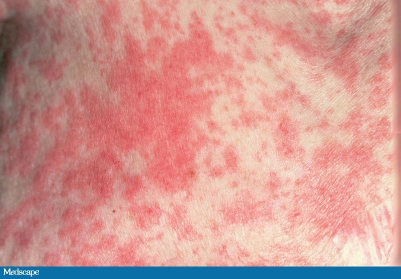 A 75-Year-Old Woman With Fever, Rash, and Skin Pain - Page 2