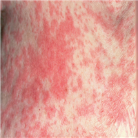 A 75-Year-Old Woman With Fever, Rash, and Skin Pain - Page 2