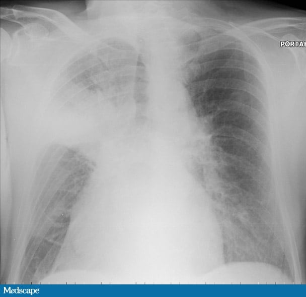 a-74-year-old-man-with-easy-bruising-and-fatigue-page-2