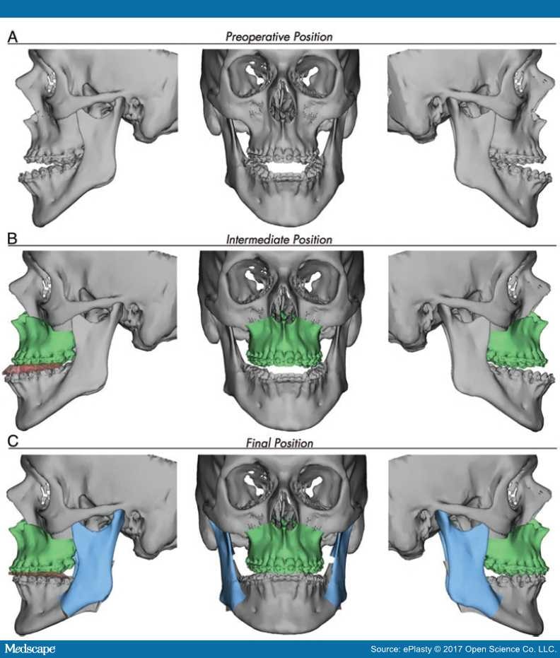 Virtual Surgical Planning in Orthognathic Surgery